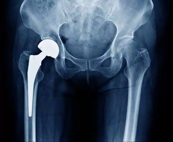 Hip Replacement Law Suit
