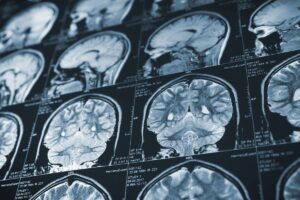 Brain Injury X-ray